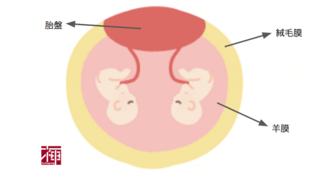 一絨毛膜一様膜 MM双胎