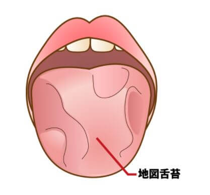 舌が白い 原因